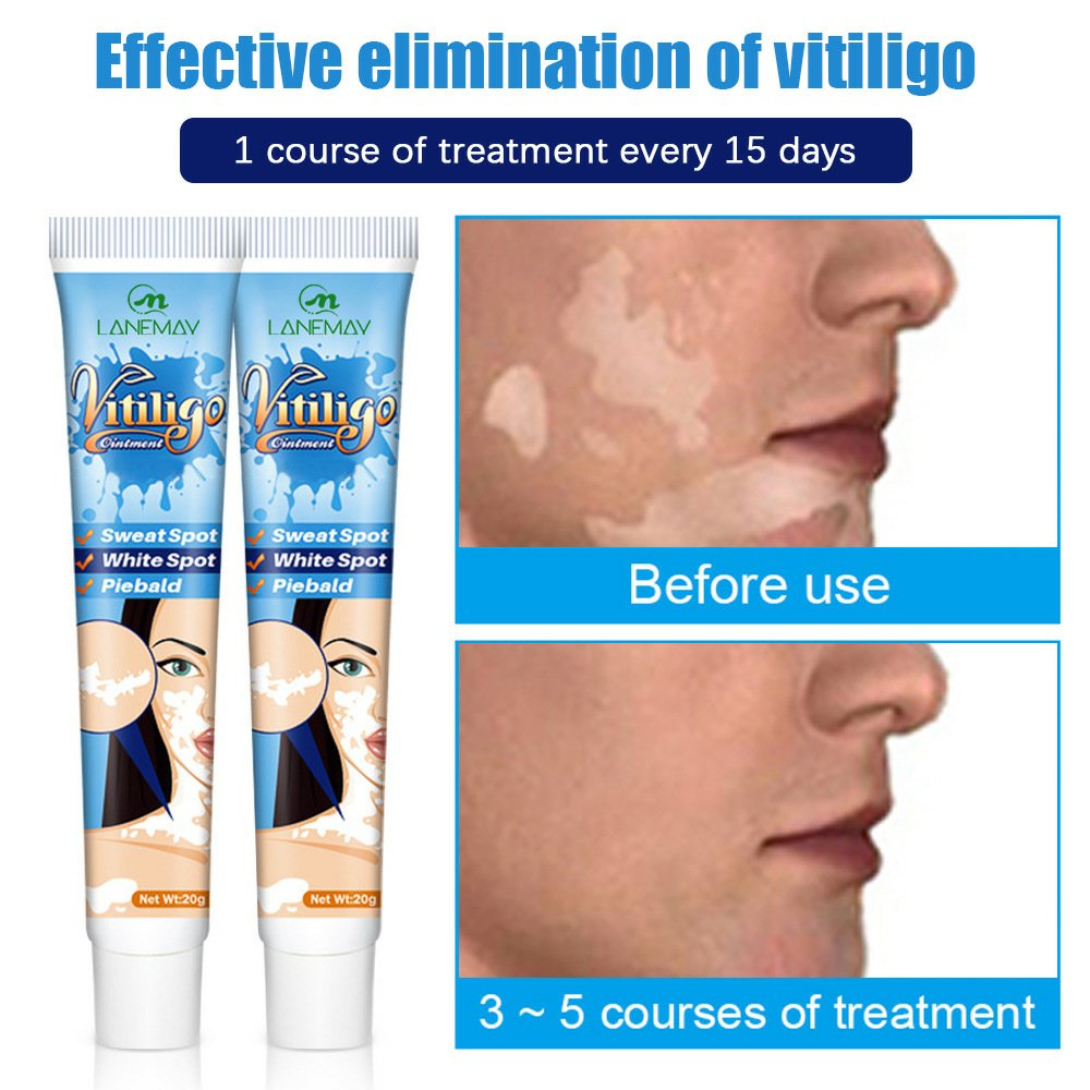 Pommade Vitiligo aux extraits de plantes – Image 3